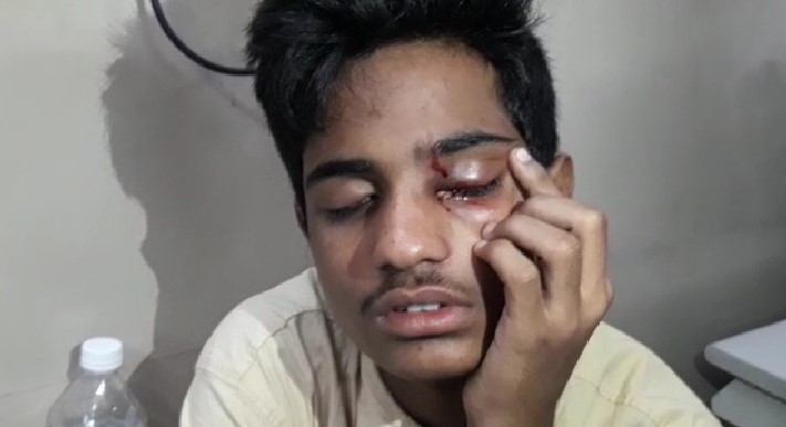 44 treated for eye injuries at Sarojini Devi Eye Hospital, Hyderabad