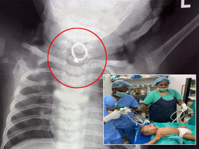 Ring struck in Nizamabad infant’s throat removed successfully