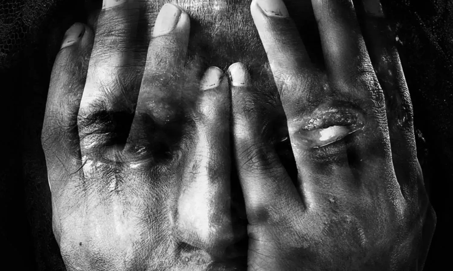 Biker throws acid on 26YO tribal woman in Jagtial