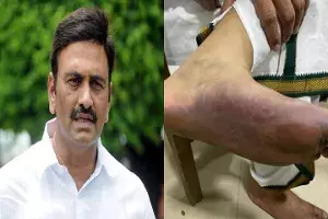 SC orders medical test for Raghu Rama Krishna Raju after allegations of custodial torture SC orders medical test for Raghu Rama Krishna Raju after allegations of custodial torture