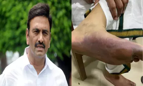 SC orders medical test for Raghu Rama Krishna Raju after allegations of custodial torture