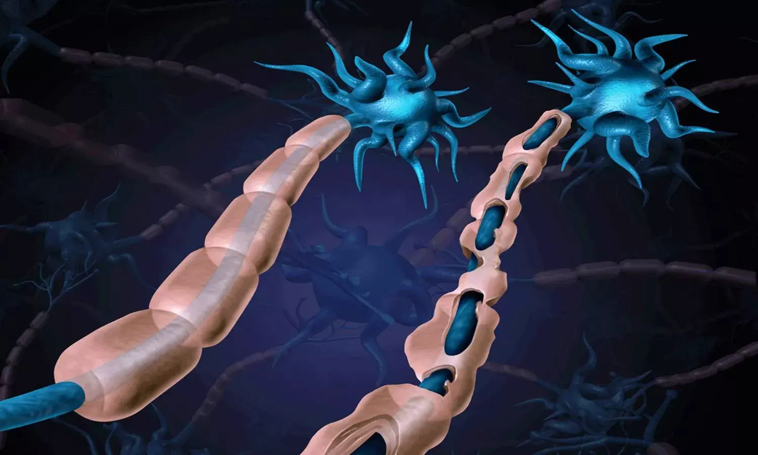World Multiple Sclerosis Day 2021: Here is an explainer into this auto-immune disease
