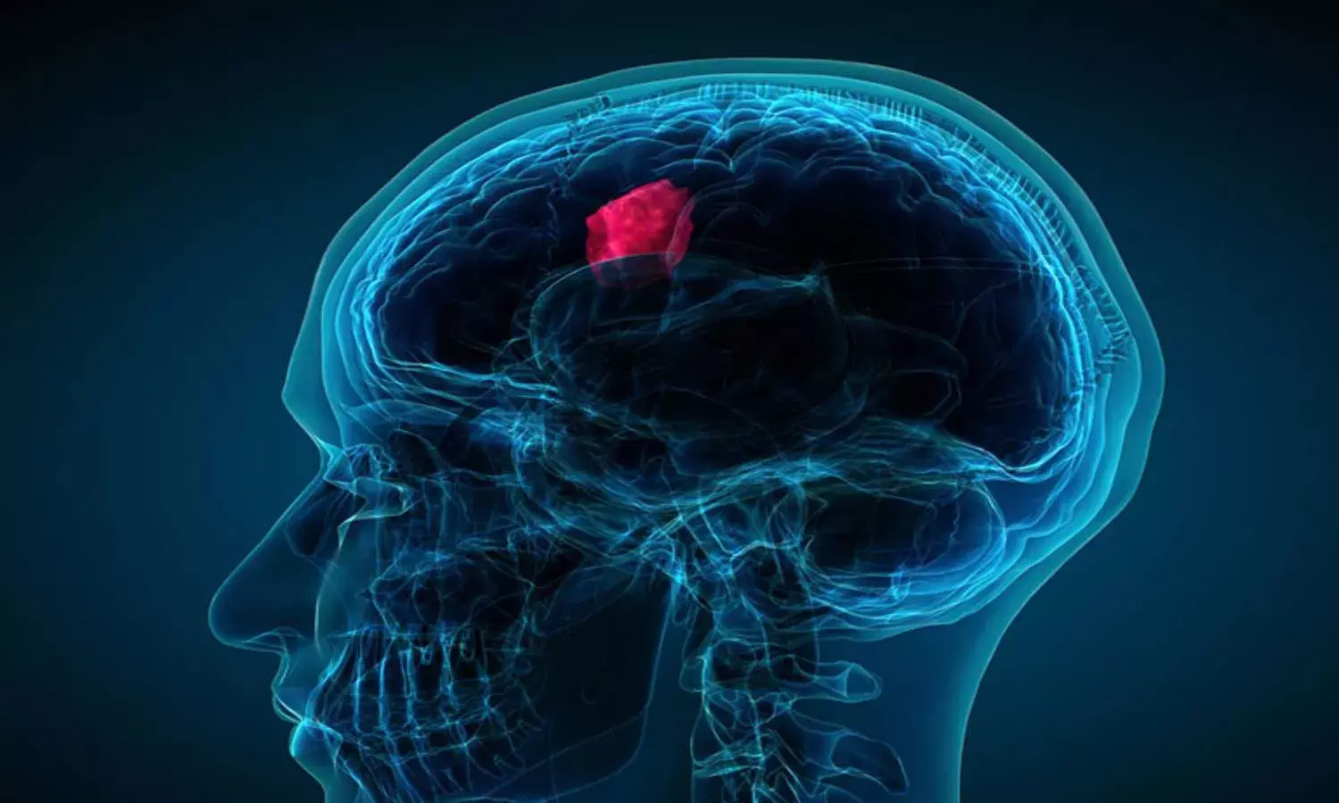World Brain Tumor Day: Understanding brain tumors