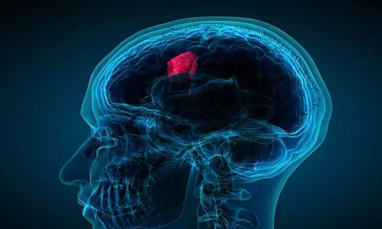 World Brain Tumor Day: Understanding brain tumors
