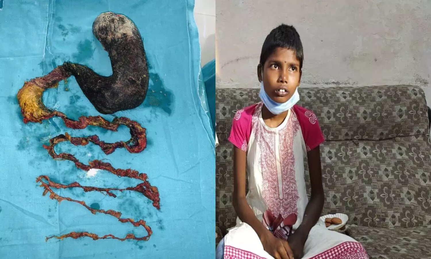Rapunzel syndrome: Docs remove 2 kg hair mass from 17YO Telangana girls stomach Rapunzel syndrome: Docs remove 2 kg hair mass from 17YO Telangana girls stomach