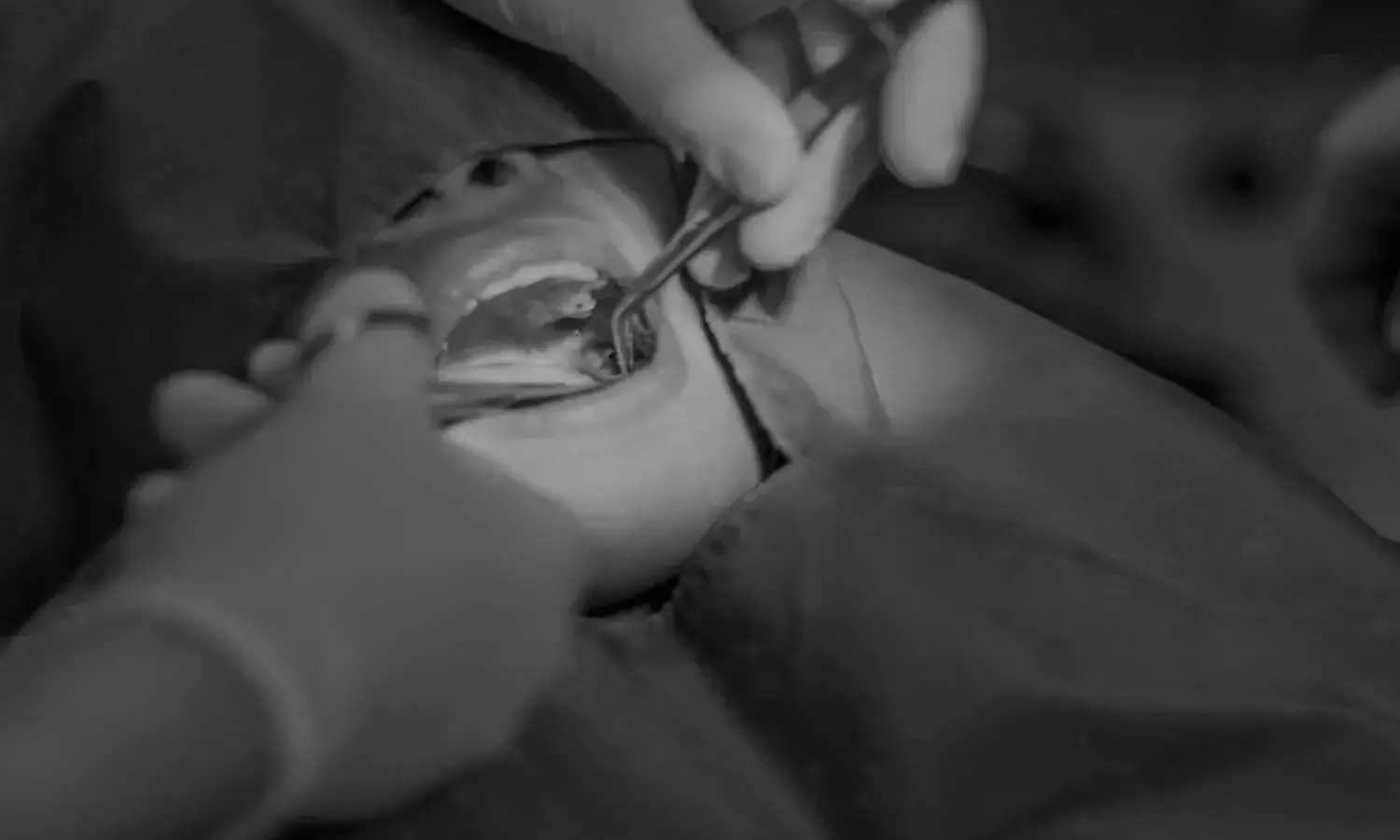 India spent around Rs. 2,386 crores in 2020 on oral cancer treatment: Study