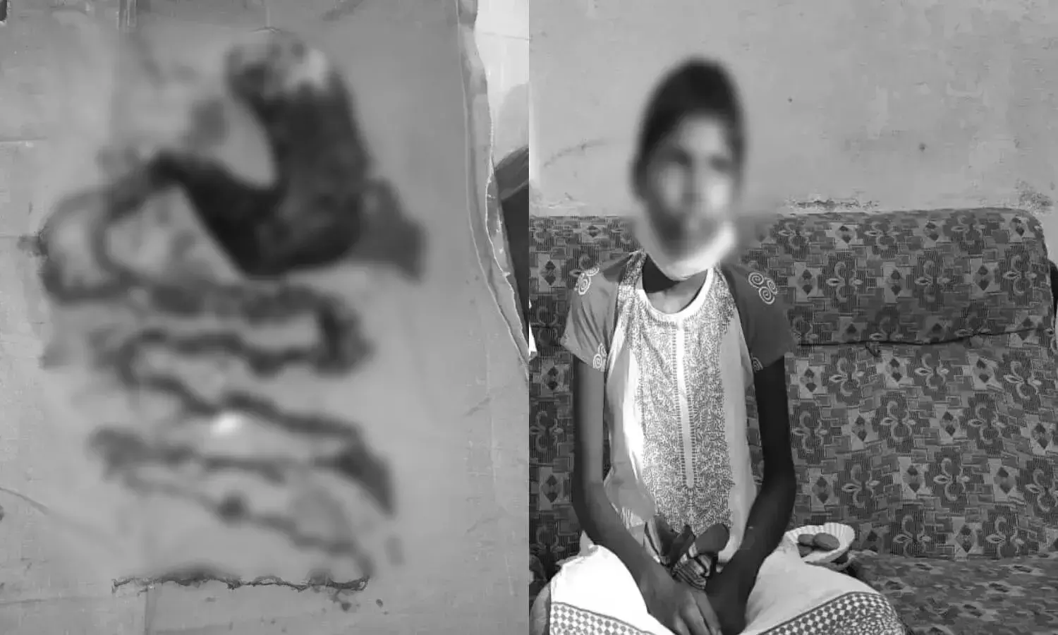 Rapunzel syndrome: Docs remove 2 kg hair mass from 17YO Telangana girls stomach