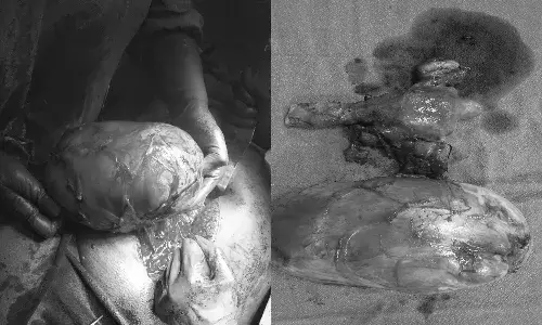 Hyderabad: Doctors at city hospital successfully remove giant mass from 44YO woman