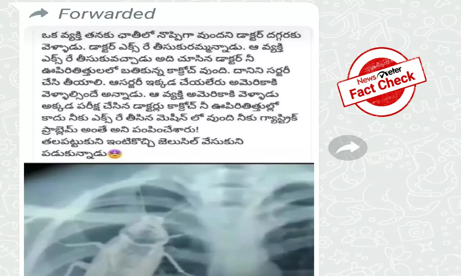 Fact Check: Did Doctor find a cockroach in a patients radiograph?