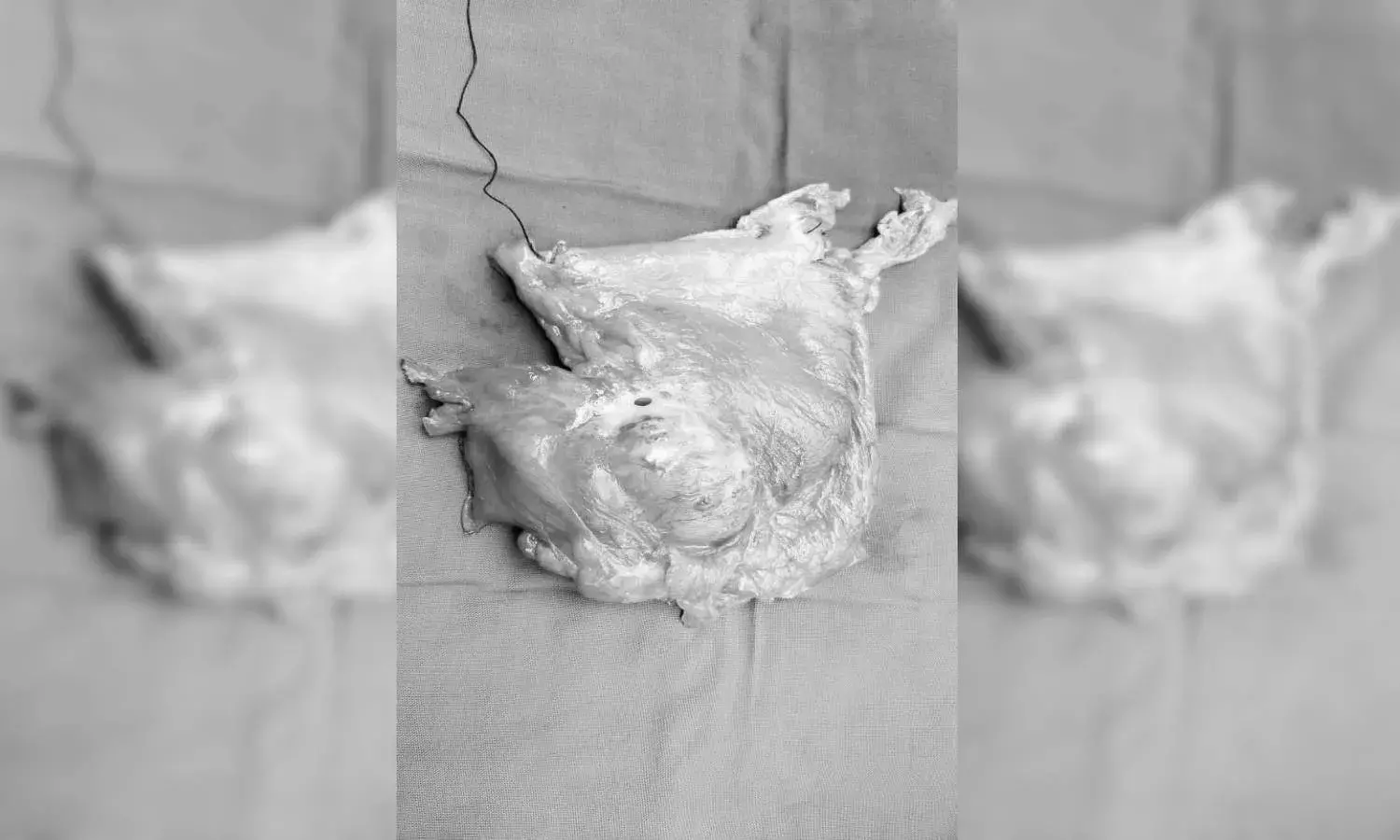 Hyderabad woman treated for rare, life-threatening perforated stomach cancer