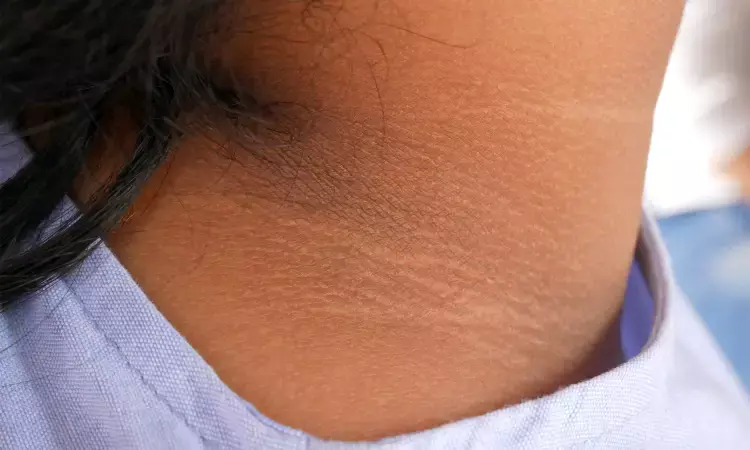 Acanthosis Nigricans: Home Remedies for Velvety Dark Neck