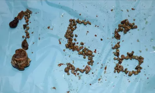 Medical miracle: 156 kidney stones removed from 50YO man in Hyderabad