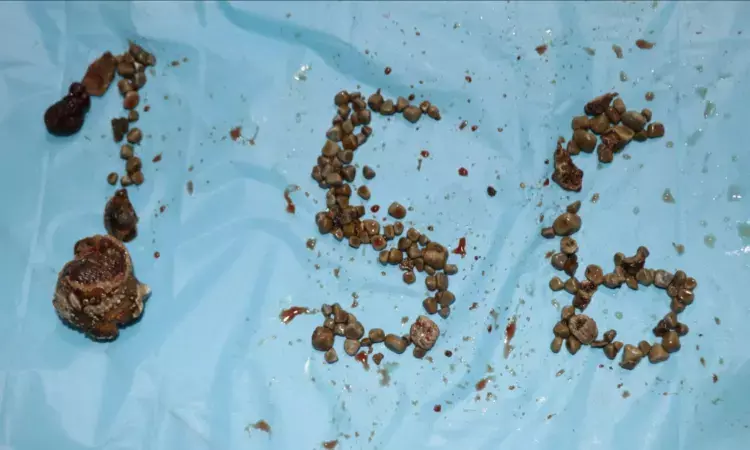 Medical miracle: 156 kidney stones removed from 50YO man in Hyderabad