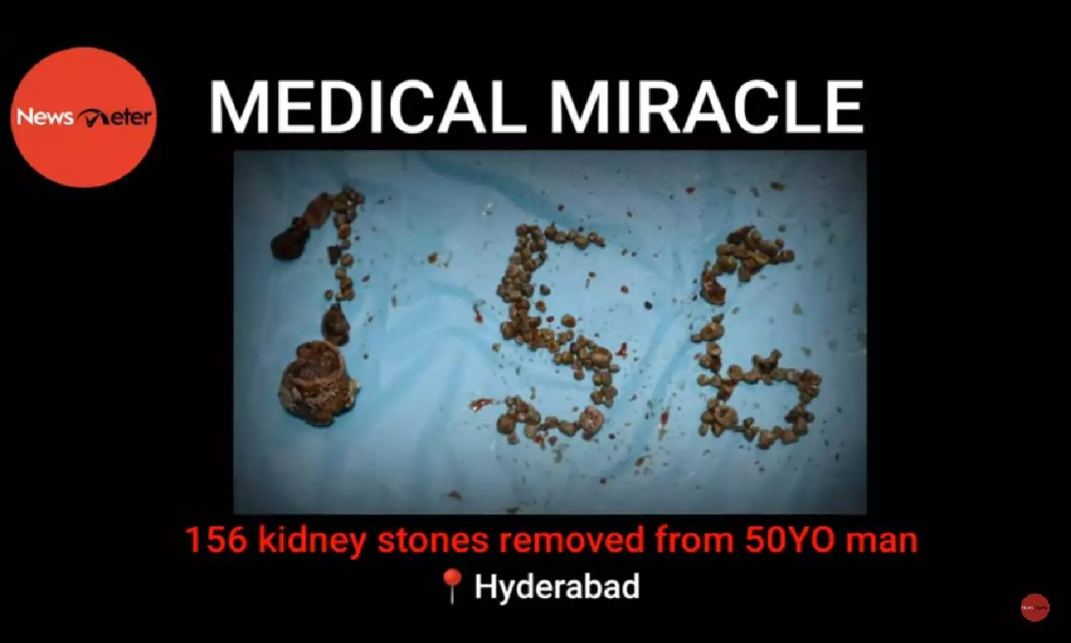 Medical Miracle: 156 kidney stones removed from 50YO man in Hyderabad