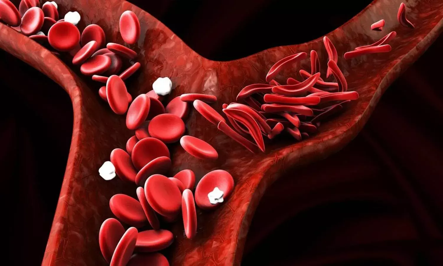 Hydroxyurea gets DCGI approval for sickle cell anaemia treatment