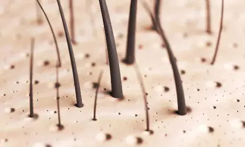 Premature Hair Loss: 10 Reasons for Hair Fall at Young Age