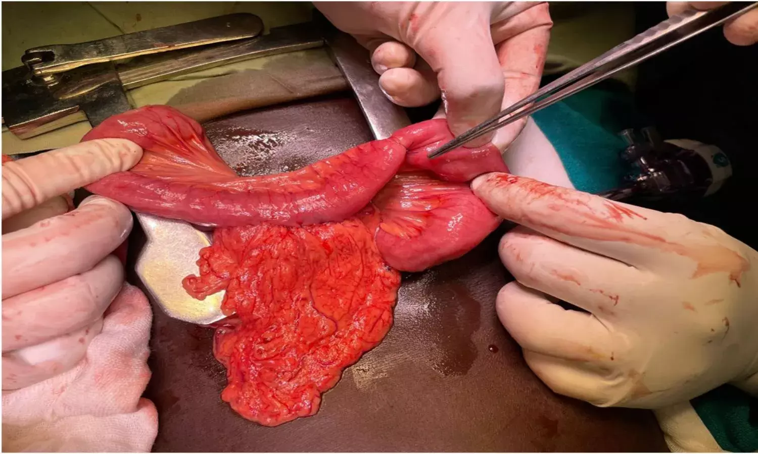 4 children with rare genetic liver disorder treated in Hyderabad hospital