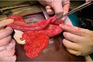 4 children with rare genetic liver disorder treated in Hyderabad hospital 4 children with rare genetic liver disorder treated in Hyderabad hospital