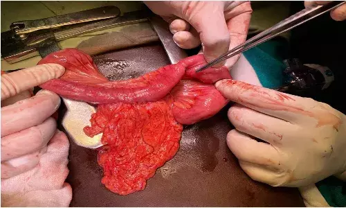 4 children with rare genetic liver disorder treated in Hyderabad hospital