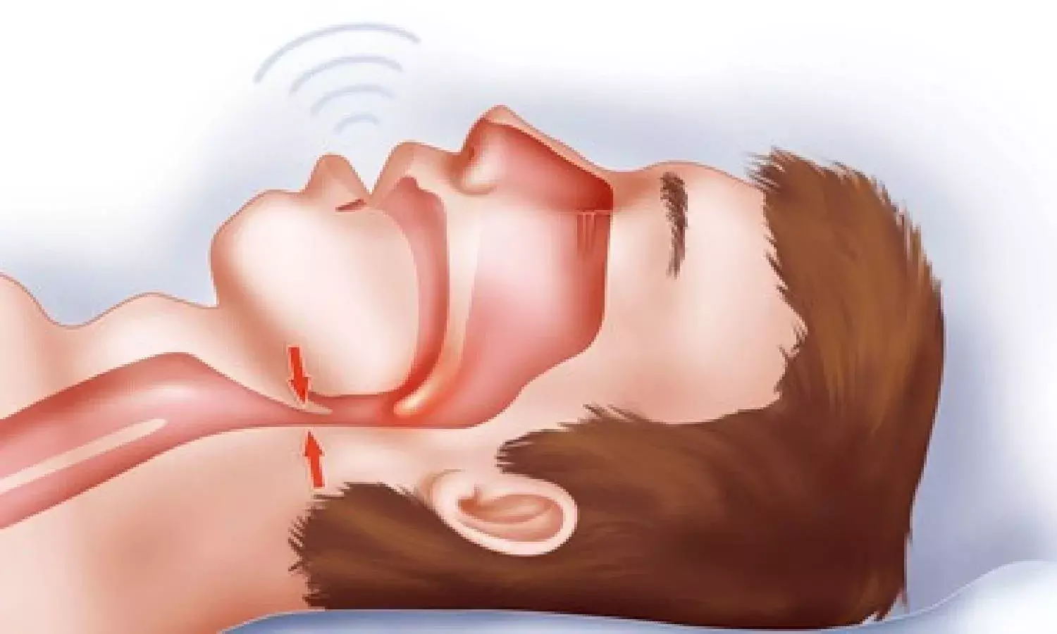 Explained: Obstructive sleep apnea, causes, symptoms