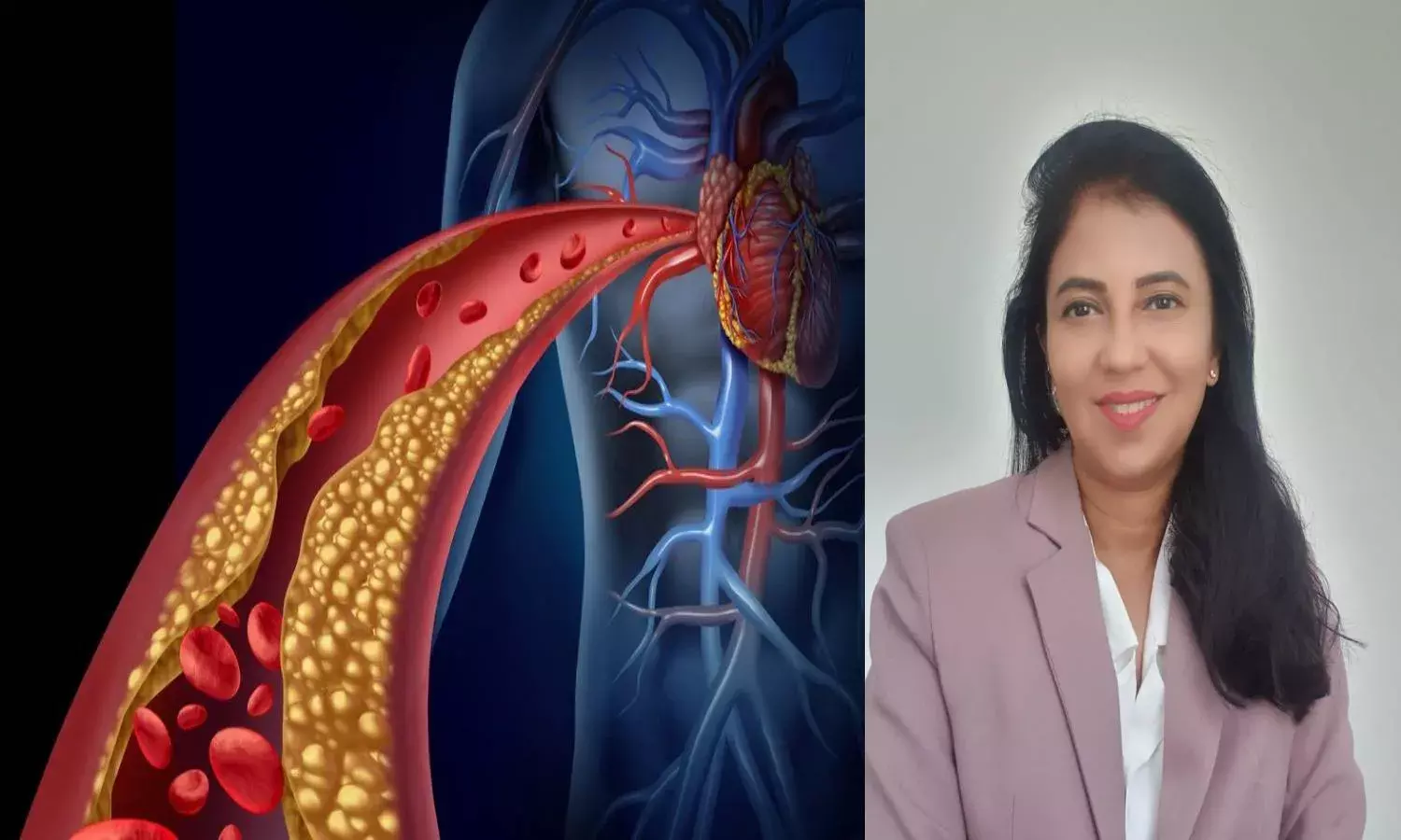 Does high cholesterol cause heart attack?