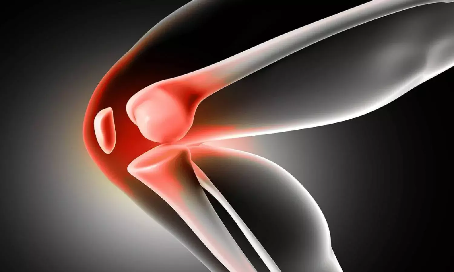 Gandhi Hospital performs 6 knee replacement surgeries in a day