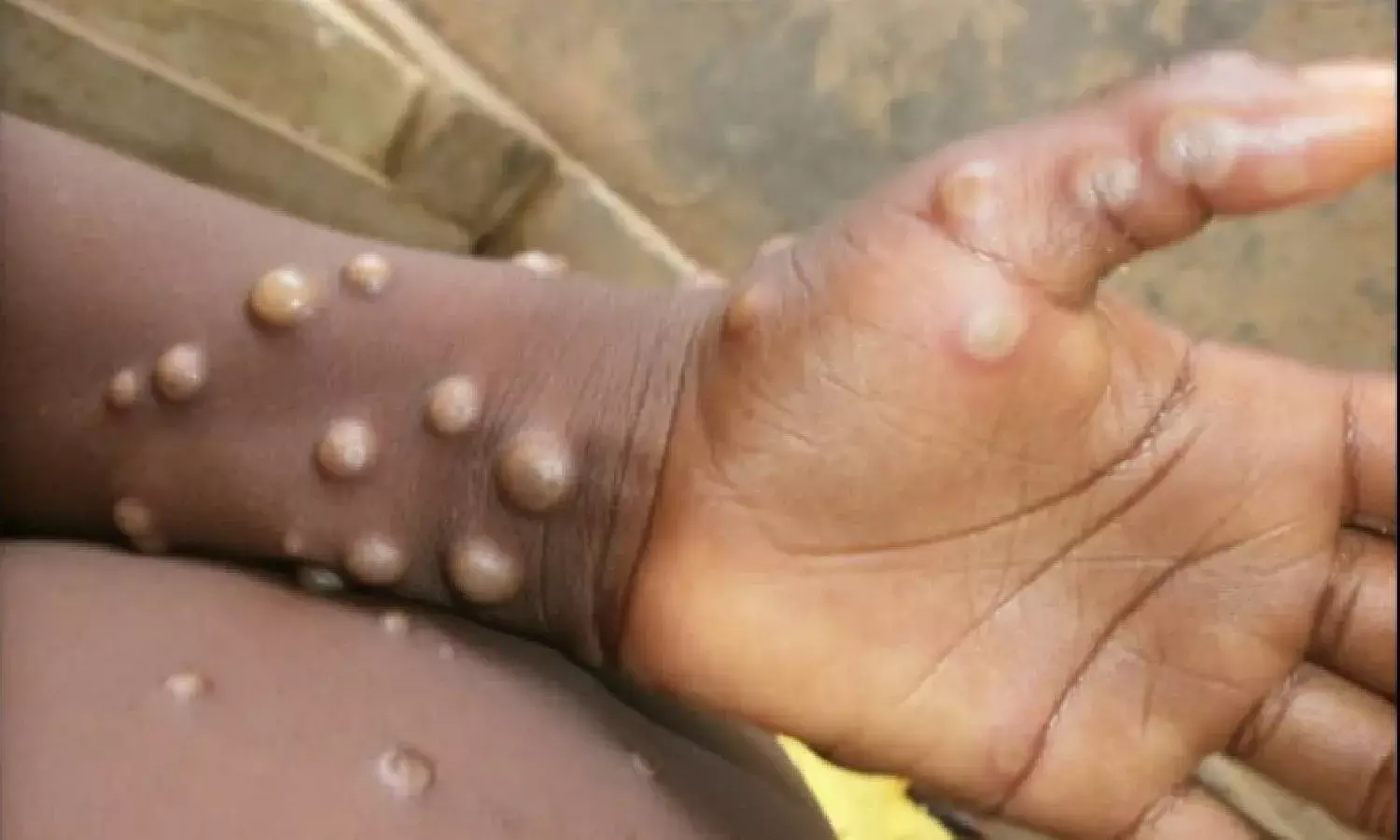 What is Monkeypox? Here are the symptoms and prevention tips