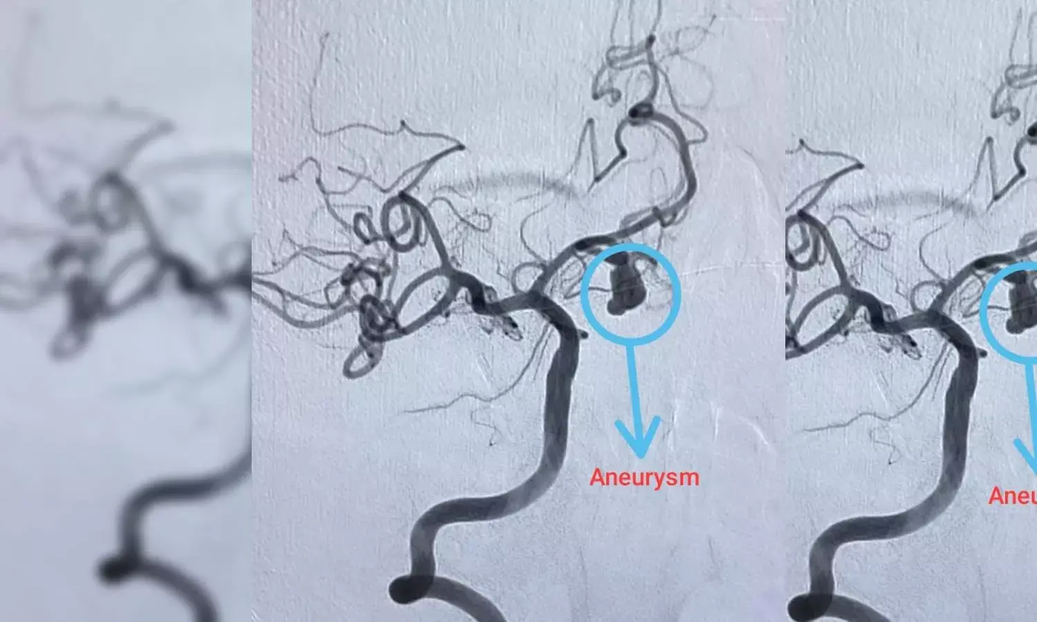 Hyderabad hospital successfully removes rare, berry-like aneurysm