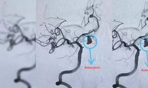 Hyderabad hospital successfully removes rare, berry-like aneurysm