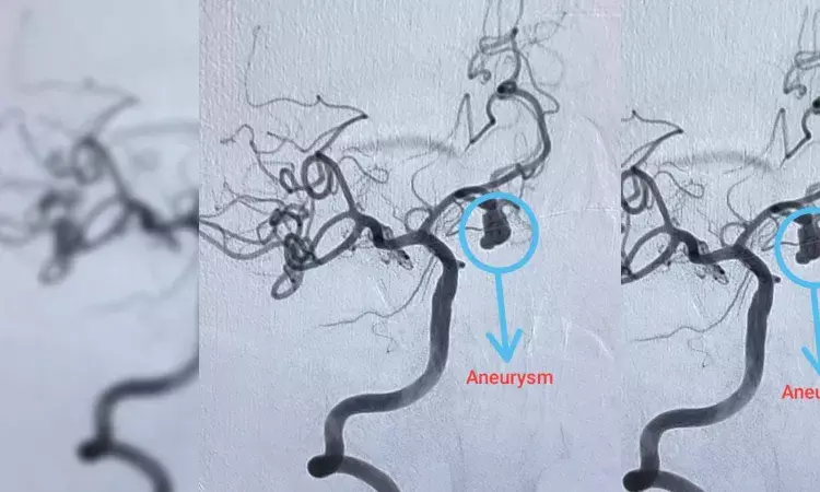 Hyderabad hospital successfully removes rare, berry-like aneurysm