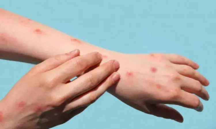 Sudden demand for smallpox vaccine in fight against monkeypox