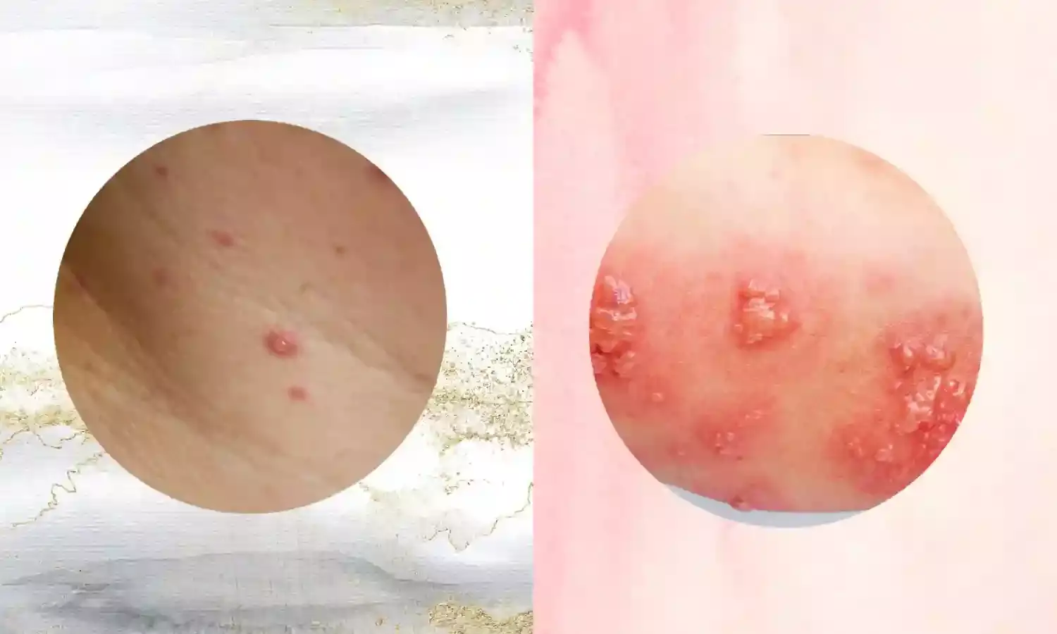 Monkeypox: Telanganas first sample negative but another suspected case notified