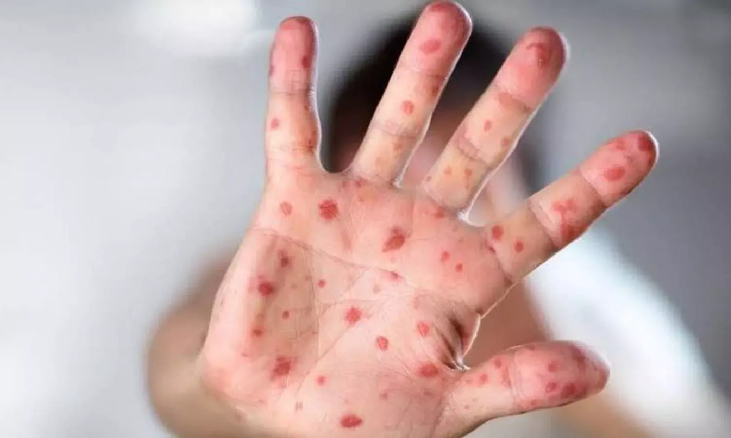 Monkeypox: Scientists call for genome sequencing, monitoring patients for herpes