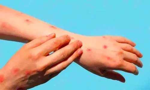 Explained: What is tomato flu and should you be worried?