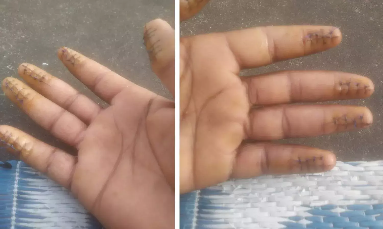 Finger Tip-Surgery: How 2 Kadapa men helped deportees re-enter Kuwait