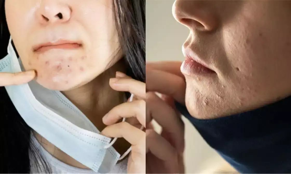 Pimples, acne, itching: Prolonged mask use leads to facial distress