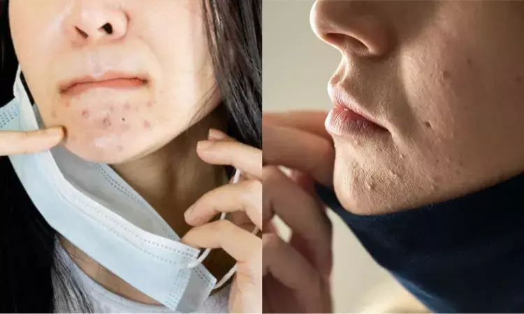 Pimples, acne, itching: Prolonged mask use leads to facial distress