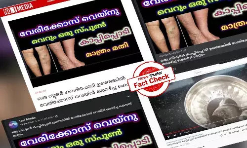 കാപ്പിപ്പൊടി വെരിക്കോസ് വെയിനിന് പരിഹാരമെന്ന്  പ്രചരണം; ശുദ്ധ അസംബന്ധമെന്ന് ആരോഗ്യ വിദഗ്ധര്‍
