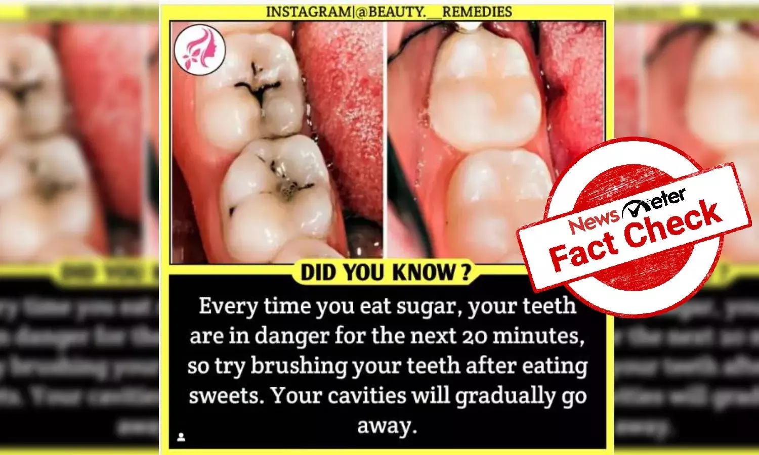 No, tooth decay or cavity cannot be reversed