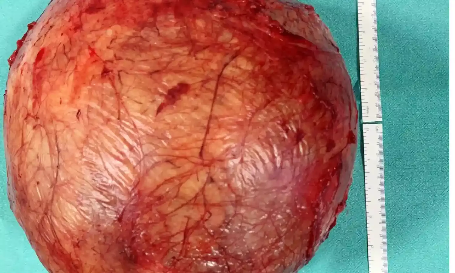 10 kg football-sized abdominal tumor removed in Hyd hospital