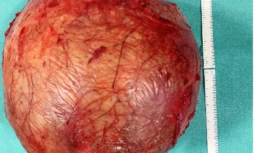 10 kg football-sized abdominal tumor removed in Hyd hospital