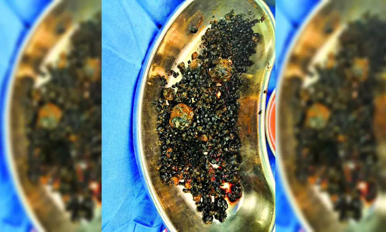 1,000 stones extracted from liver, gall bladder, bile duct of 39YO man