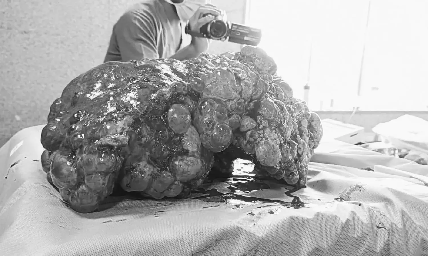 Doctors at Hyd Hospital remove 12 kg liver from West Bengal woman