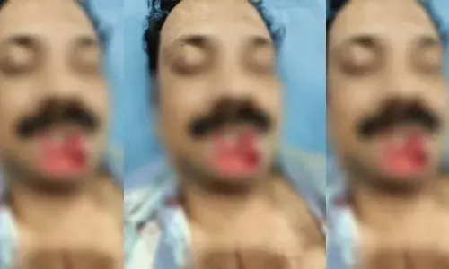 Vizag man bites off neighbours lower lip, attacks his family