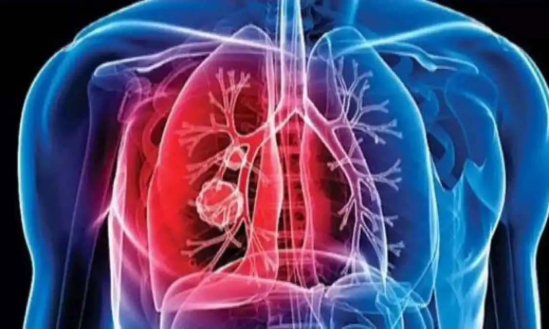 Covid-19 impact: 7% TB patients in India forced to discontinue medicines during lockdown