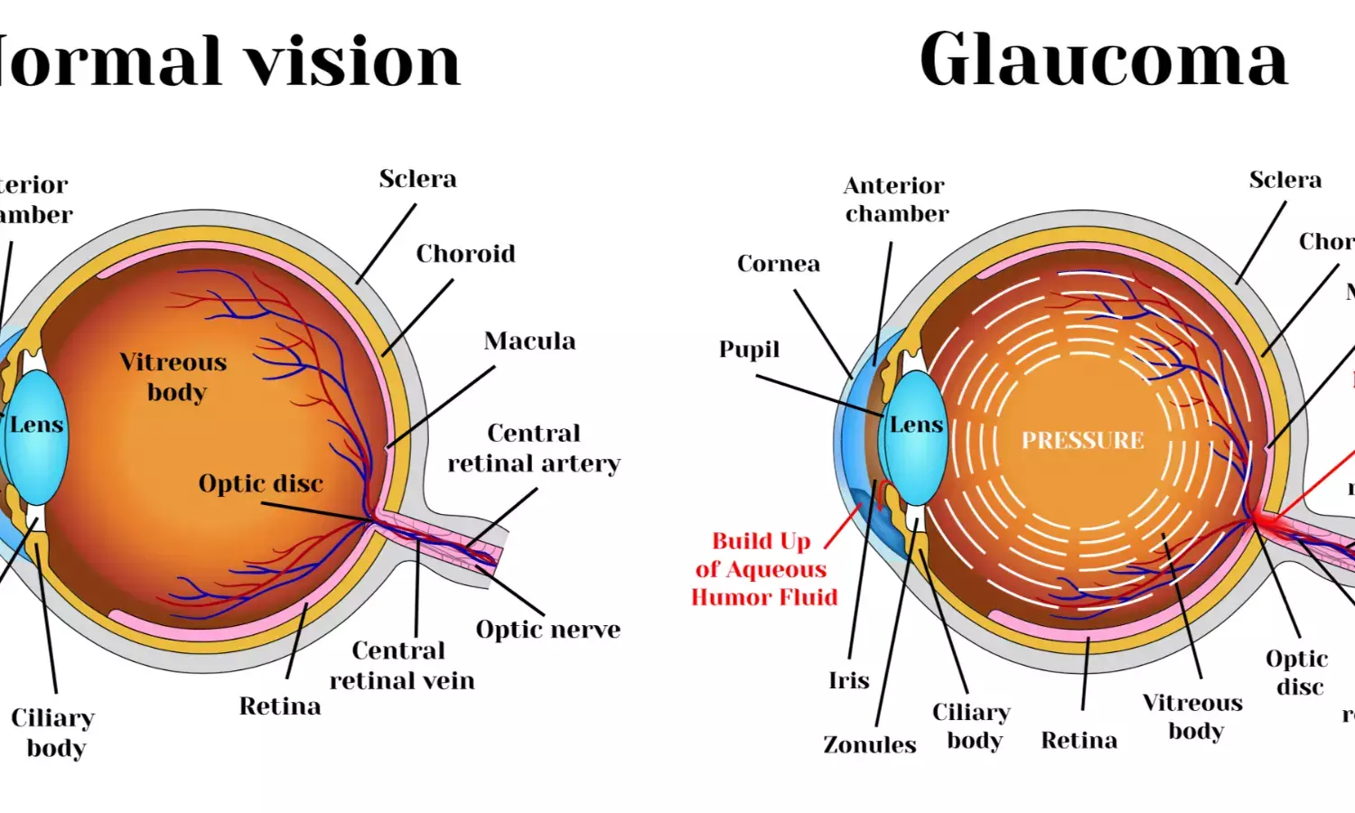 Guard against Glaucoma, the silent thief of vision