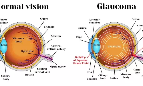 Guard against Glaucoma, the silent thief of vision