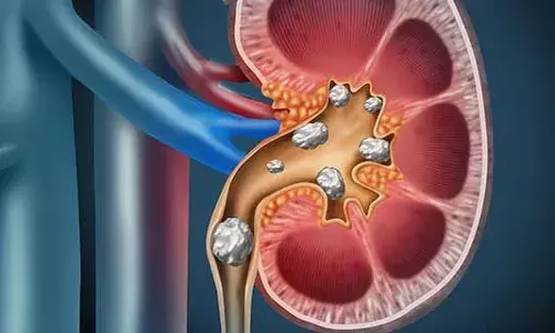Hyderabad AINU doctors successfully remove urinary bladder stones from a 3YO boy