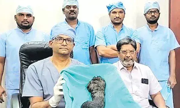 Trichobezoar: How doctors removed one-kilo hair from 14YO girls stomach in Guntur