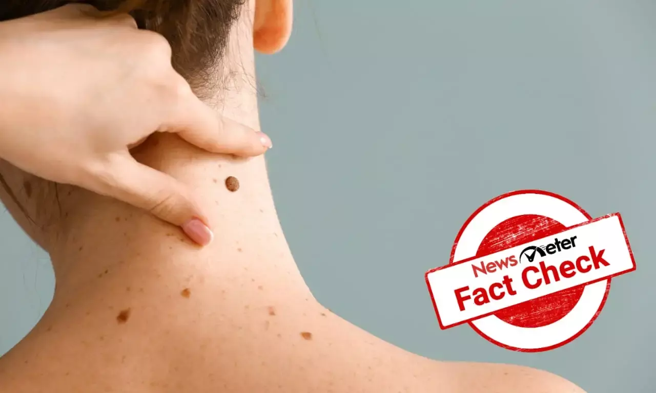 Wart and mole removers do not work; don’t fall for such products